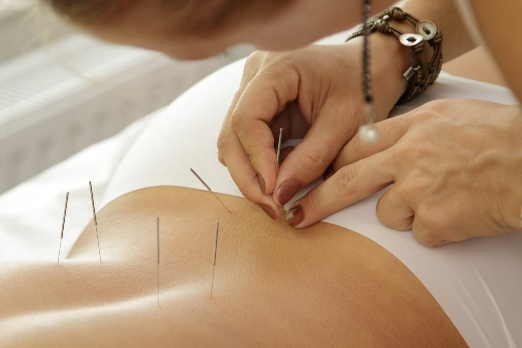 Acupuncture